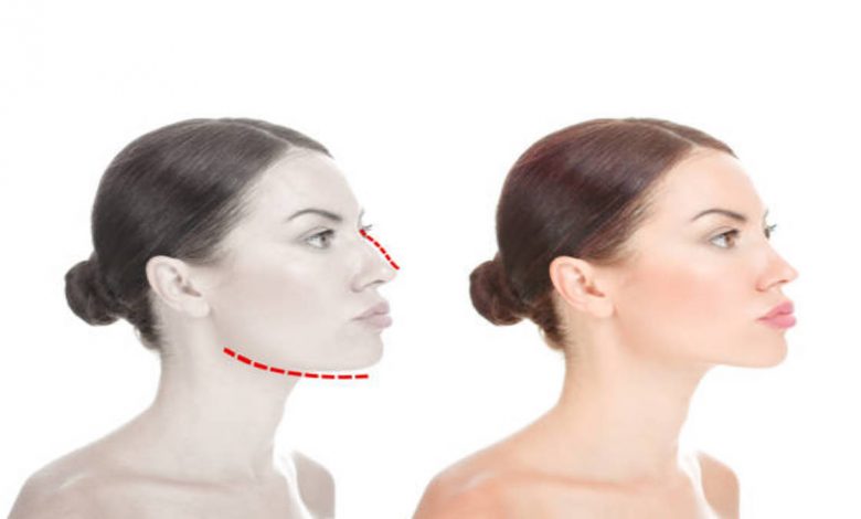 kybella beverly hills