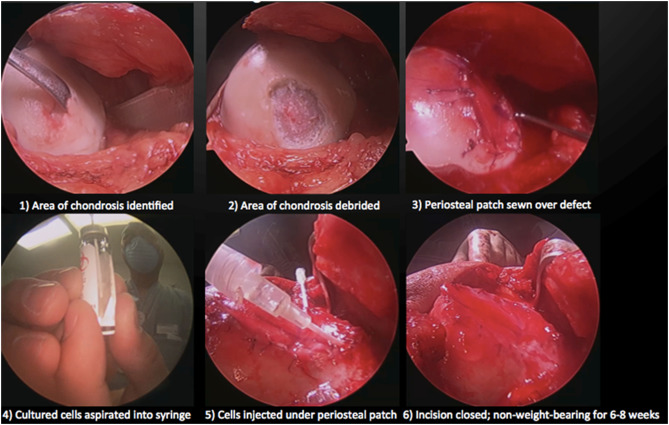 Mild-Patellar-Chondrosis-in-The-Knee