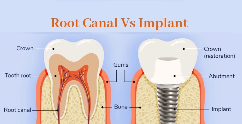 root canal treatment in kolkata