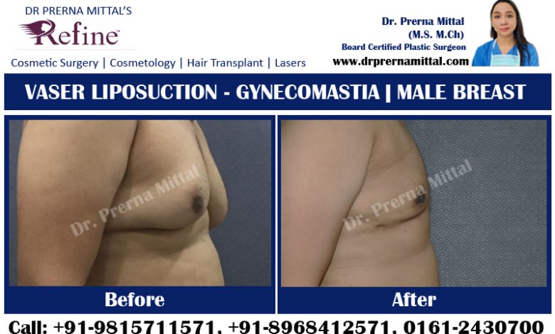 Gynecomastia in punjab