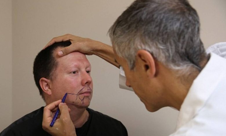 beard transplant treatment