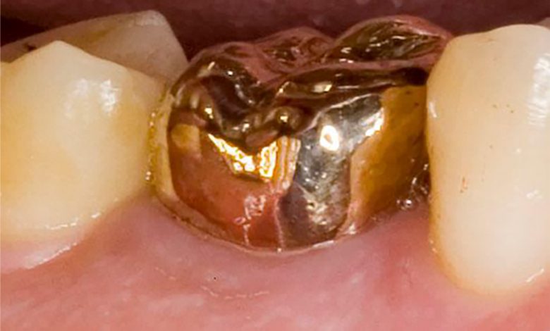 gold tooth implant